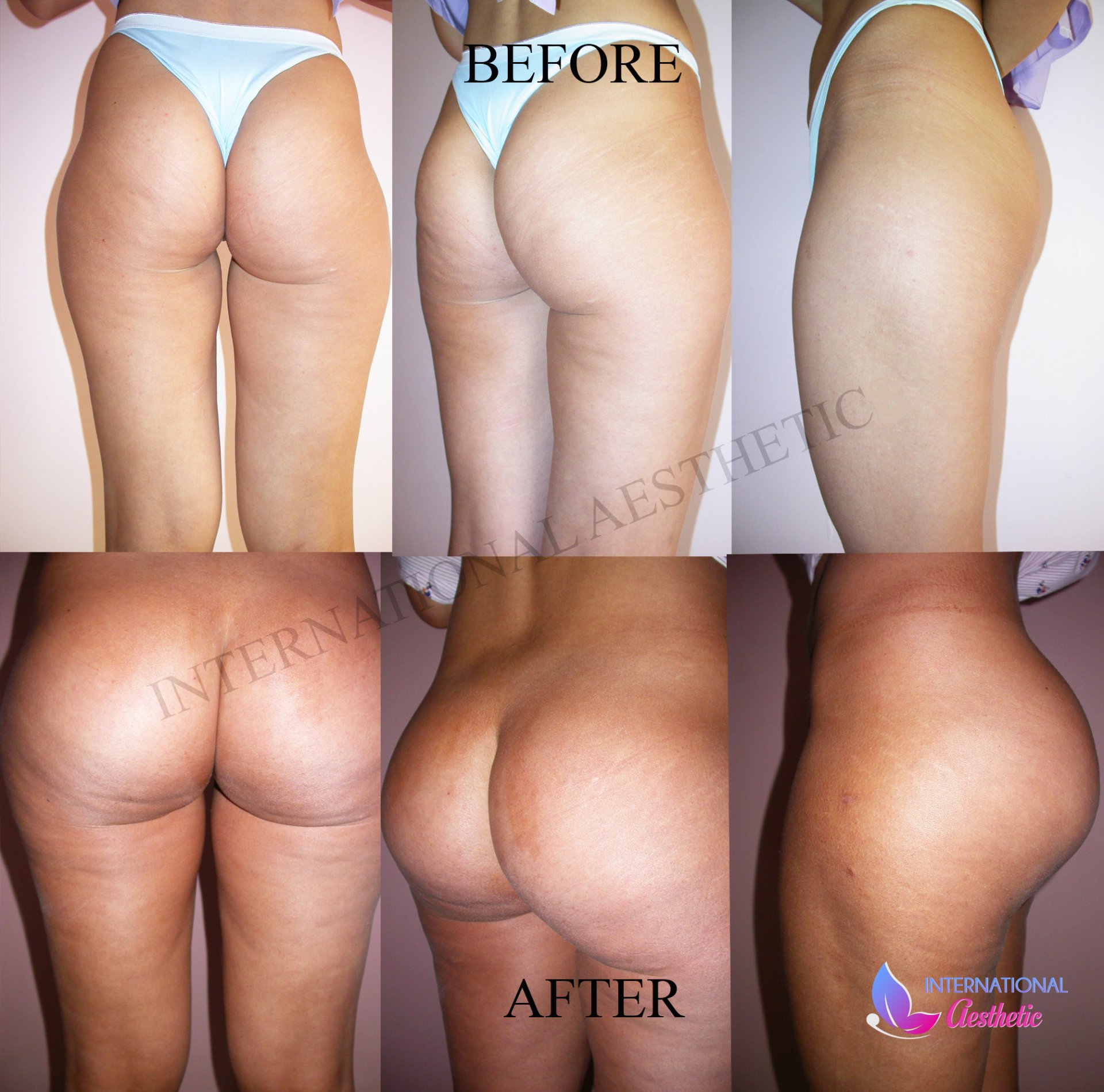 Brazilian Butt Lift