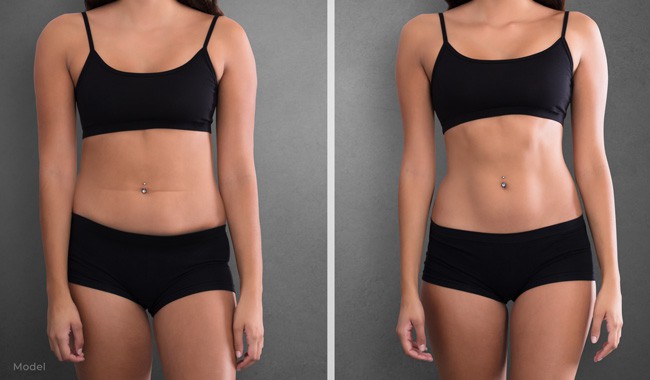 Liposuction
